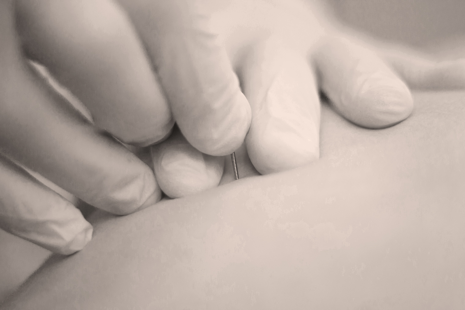 Puncture physiothérapique sur cadavre