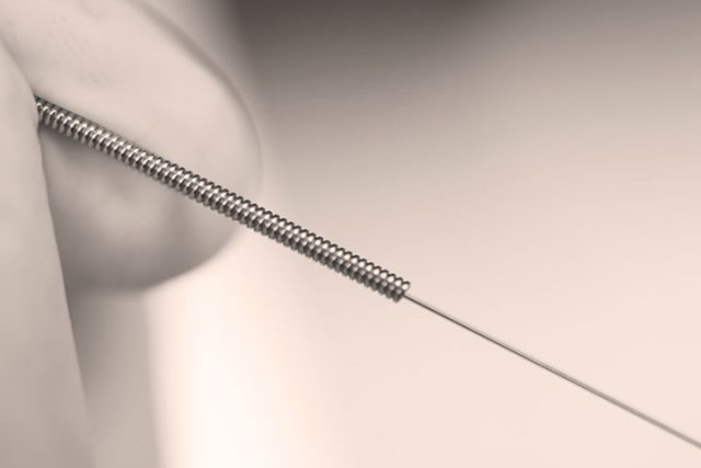 Puncture physiothérapique avec aiguilles sèches: cours de base