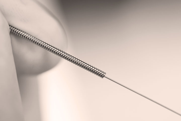 Formation OPPQ-Puncture physiothérapique avec aiguilles sèches: cours de base et punctures avancées et révision